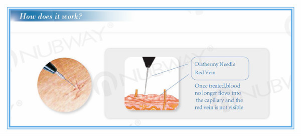 Painless safety high frequency 30MHZ spider vein removal and varicose vein treatment