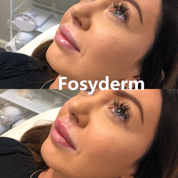 Línea atractiva transparente llenadores cutáneos de Derm del ácido hialurónico de los labios 1ml del labio del gel