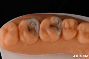 Composite Inlays And Onlays For Dental Restoration Strong Bonding To Tooth