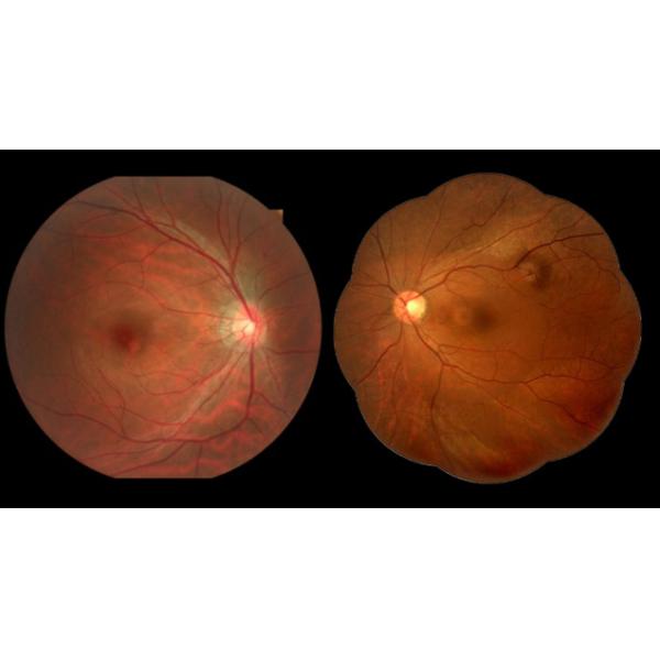 Ретинальное отображая режима зрачка камеры Fundus цифров разрешение небольшого высокое