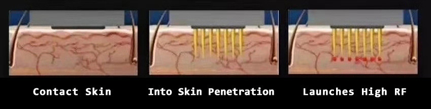 Подмолаживание 100V кожи к машине 240V Microneedle RF
