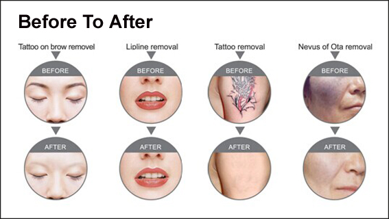 Painless SHR ELight Hair Removal Machine RF Radio Frequency Skin Tightening Machine