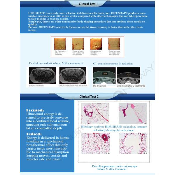 Beat fat loss effect!!! HIFU weight loss slim / HIFU shape slimming machine / hifu fat reduction device