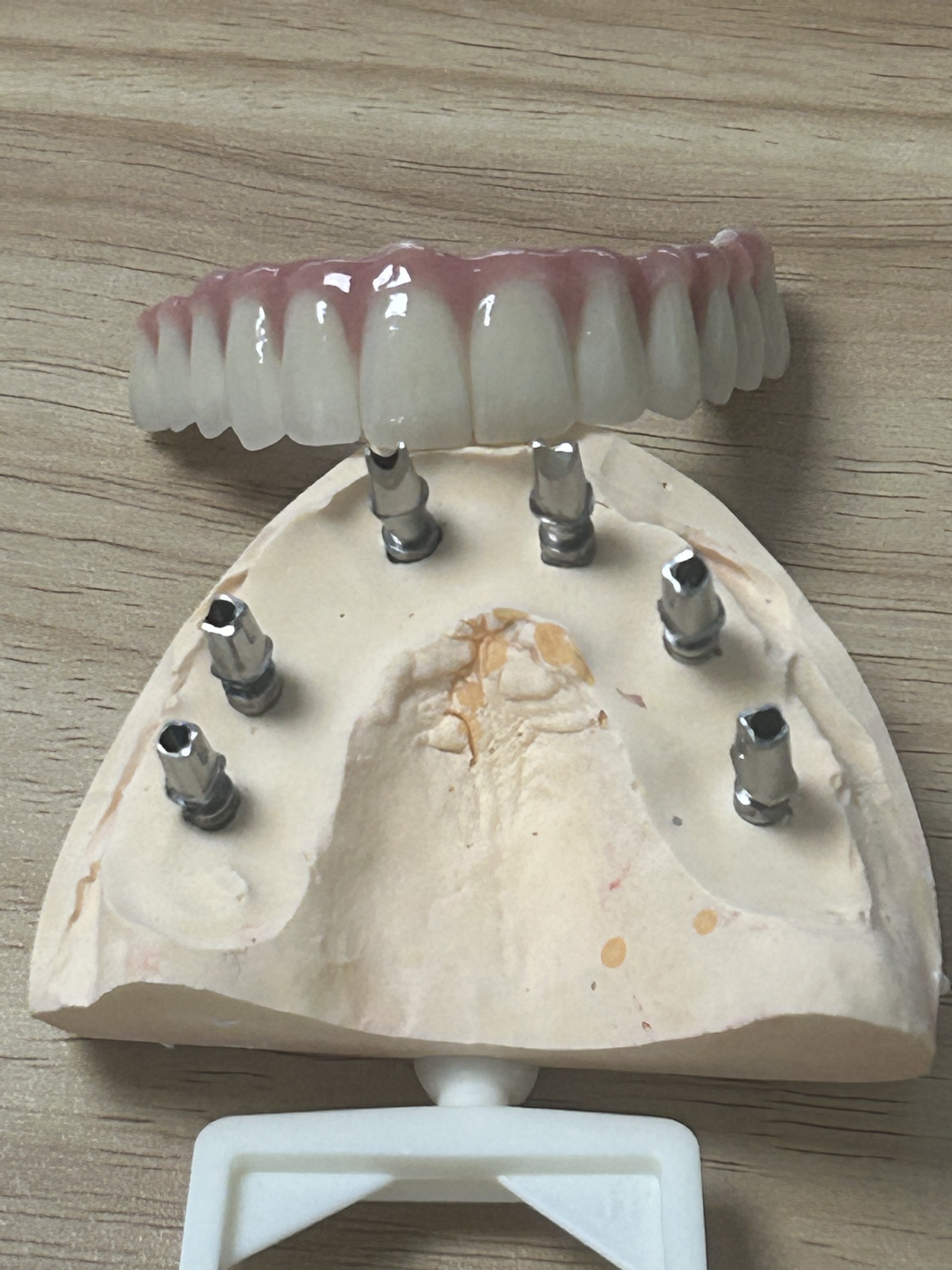 High-Strength Dental Zirconia Implant Crown with Natural Translucency & Tooth-Like Appearance via Digital CAD/CAM