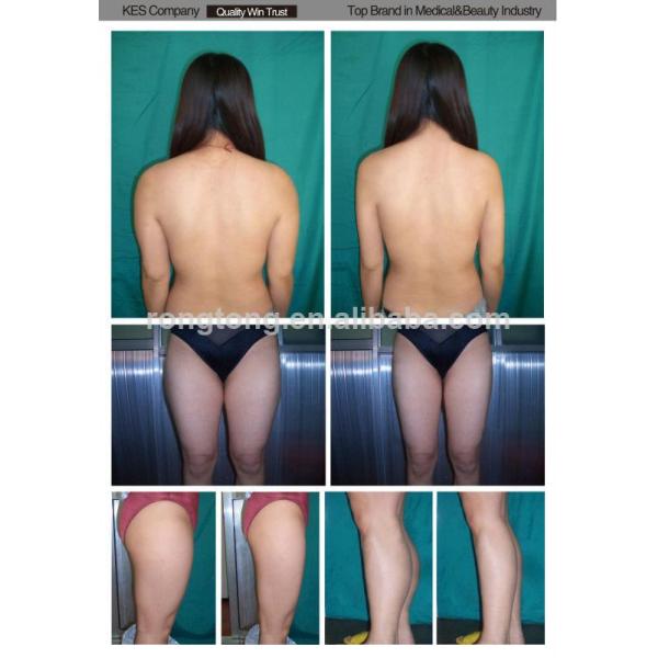 Fractional RF Skin Resurfacing Wrinkle Removal Machine 1MHz RF Beauty Equipment