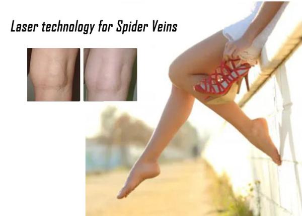 1064nm Spider Vein Removal Machine 532nm KTP Non Invasive Laser Treatment