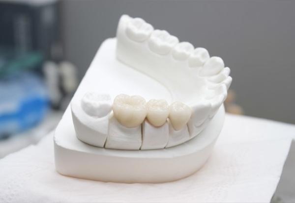 High Strength Dental Base Metal Alloys Wear Proof  Dental Casting Alloys