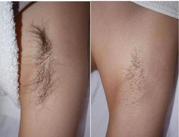 Medical CE Function IPL hair removal IPL Beauty laser machine