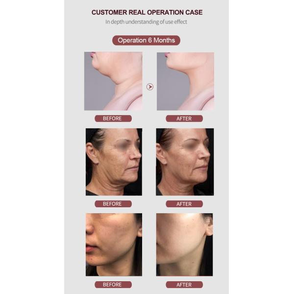 Машина 5Mhz радиочастоты подтяжки лица частичная microneedling