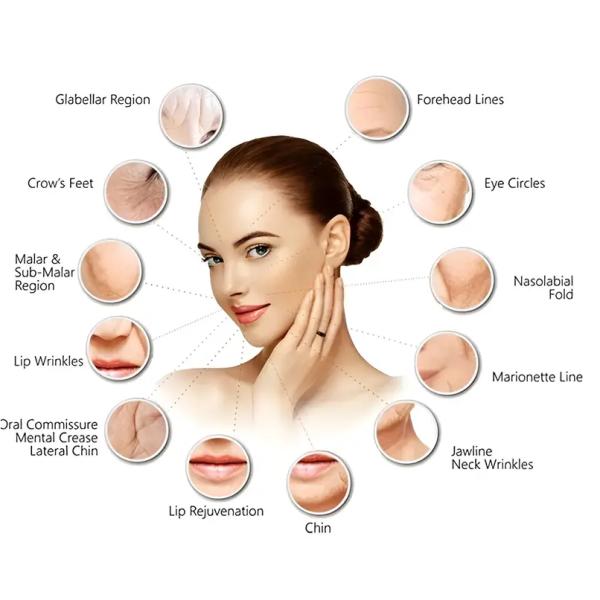 Ultra 3 Ultra 4 Juvederm Dermal Filler Инъекции наполнителей для увеличения губ с гиалуроновой кислотой