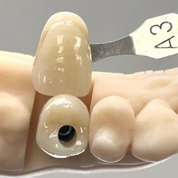 Porcelaine Zirconia Ciment Implanté à vis retenue Forme de tête hexagonale pour une esthétique personnalisée