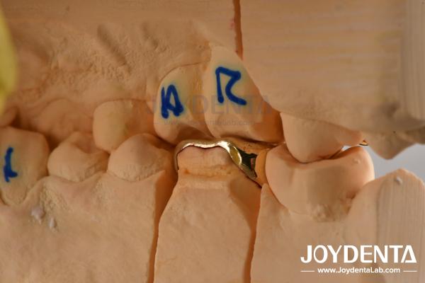Abrasive Resistance Dental Wax Casting FMC Crown For Oral Clinical Repair