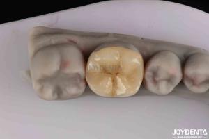 Customizable Zirconia Inlay Onlay Minimal Preparation For Damaged Teeth