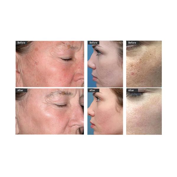 Máquina médica para el cuidado facial Helio Plasma Jet Dispositivo para el cuidado de la piel Para salón de belleza