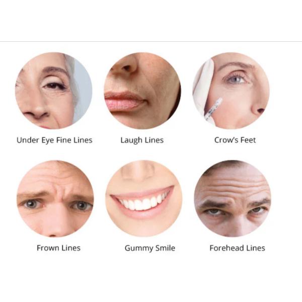 Enrugamentos Botulinum da injeção 100iu da toxina de Hyamely anti