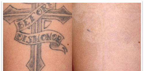 800w Pico Nd Yag Laser Tattoo Removal Machine Q - Switched Type For Beauty Salon