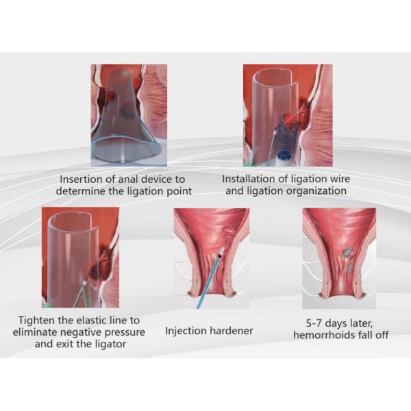 Тип локтя сшивателя геморроя Ligator автоматизации Anorectal