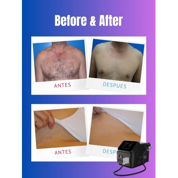 2024 Glory Pro 4 в 1 Постоянный диодный лазерный эпилятор 808nm 755nm 940nm 1064nm Красотка для омоложения кожи