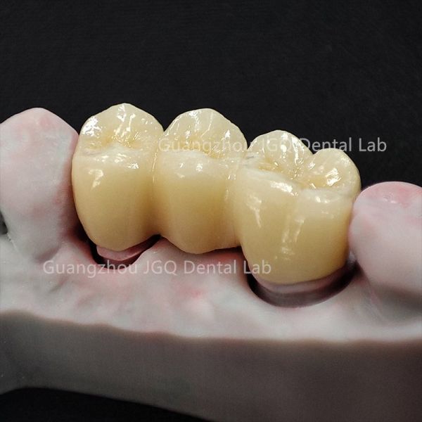 Long Lasting Zirconia Crown Bridge Precise Margin Adaptation for Dental Restoration