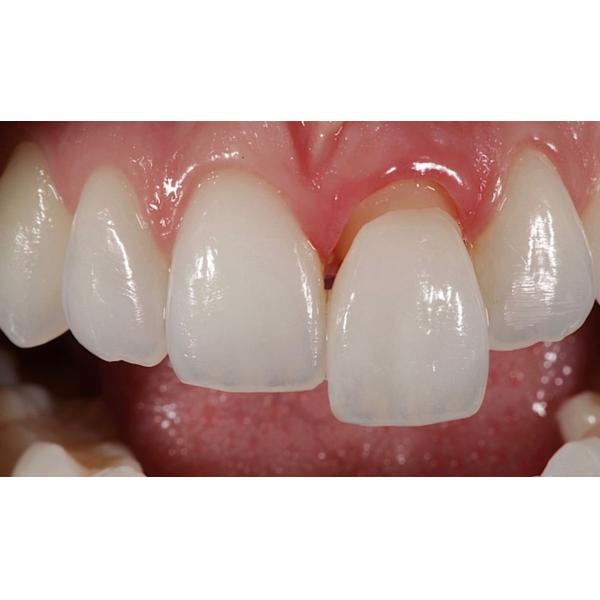 B2 D98*25mm 3D Multilayer Zirconia Block Highly Esthetic 1200 Mpa