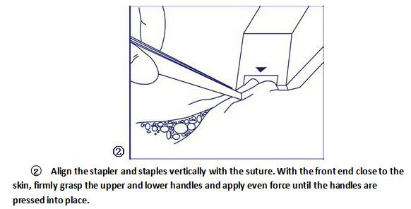 Medical Surgical Trupler Skin Stapler Machine With Scale And Remover
