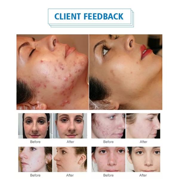 BIO Facial Beauty Therapy Machines PDT Lamp Skin Care Beauty Device 1000W