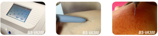 High Frequency Professional Vascular Removal Machine Spider Vein Removal Machine