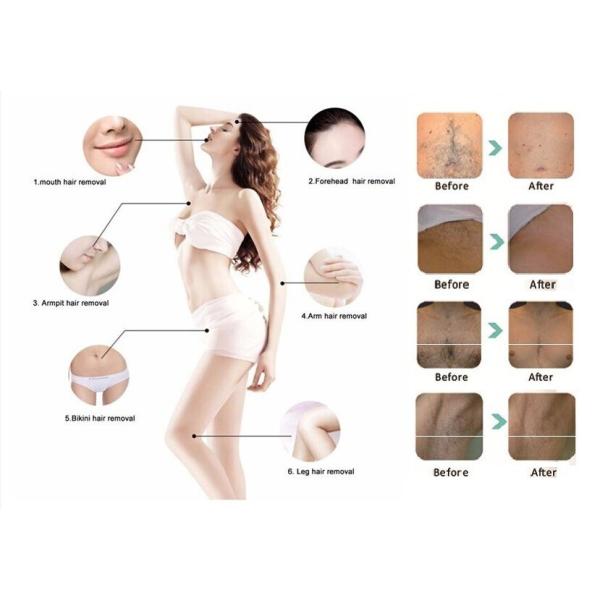 Skin Rejuvenation and Acne Pigmentation Treatment with Vertical IPL Hair Removal Machine