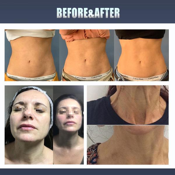 Мультифункциональная портативная 3D 4D 5D HIFU машина для подтяжки лица