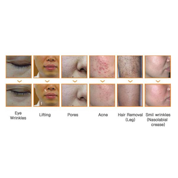 Hair Remove IPL Laser Machine