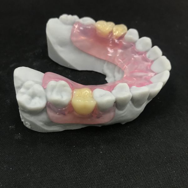 Removable Flexible Denture Valplast Flexible Partial Dentures Prothesis China Dental Lab