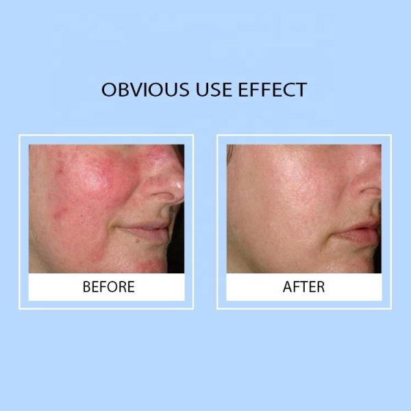 Lyz Custom Anti-Aging Moisturizing Repair Freeze-Dried Set Hyaluronic Acid Infused Copper Peptides Serum for Face Home Spa Use