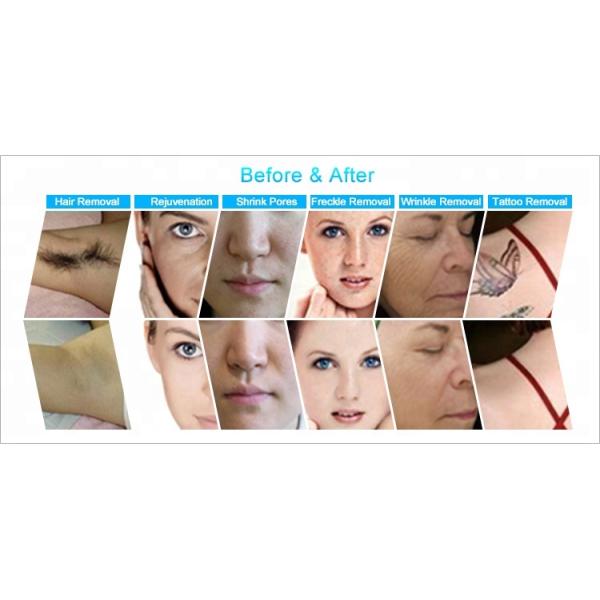 Hair Removal Skin Machine Rejuvenation Tattoo Face MJ402 Molde ROHS