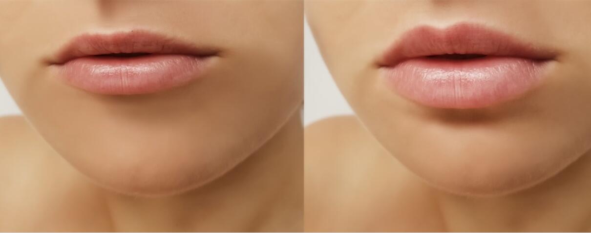 Juvederm ультра 3 вводимого заполнителя губ Hyaluronic кисловочных дермальных