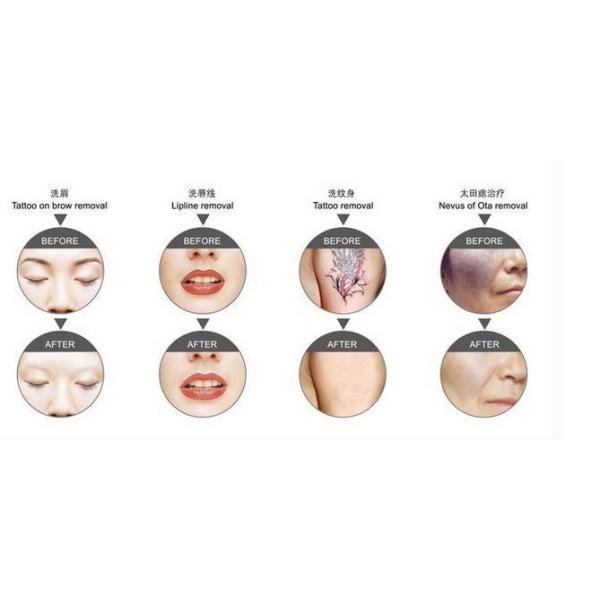 1064nm 532nm Black Doll ND YAG Laser Tattoo Removal Machine With Energy Stabilization