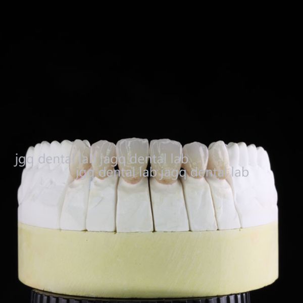 Dental Pfm Crown And Bridges Pontic Dentures Materials Dental Restorations