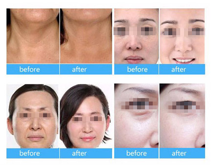 RF Ultrasound Water Microdermabrasion Machine Hydra SPA Or Facial Rejuvenation