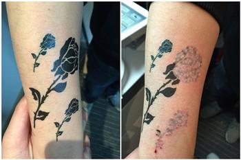 Korean imported laser arm Q Switched Nd Yag Laser tattoo removal