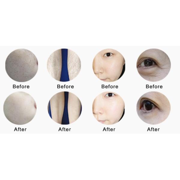 Opt Shr Wrinkle Remover Laser Hair Removal Device 1 Year Warranty