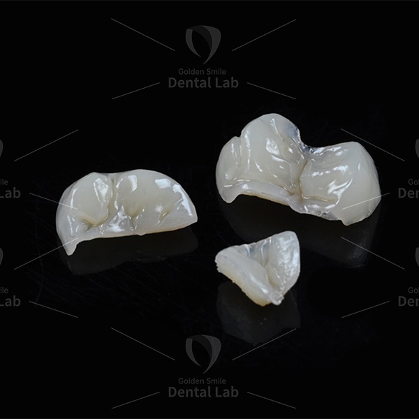Natural Composite Inlays And Onlays Ceramic Crown Dental Inlay Onlay Biocompatibility
