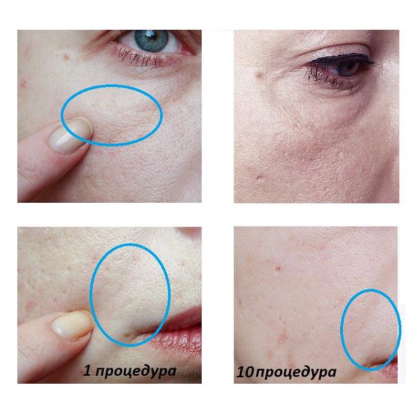 DRS 3 in 1 derma roller for face and body treatment Microneedle Roller 3 Replacement Heads Cosmetic Needling