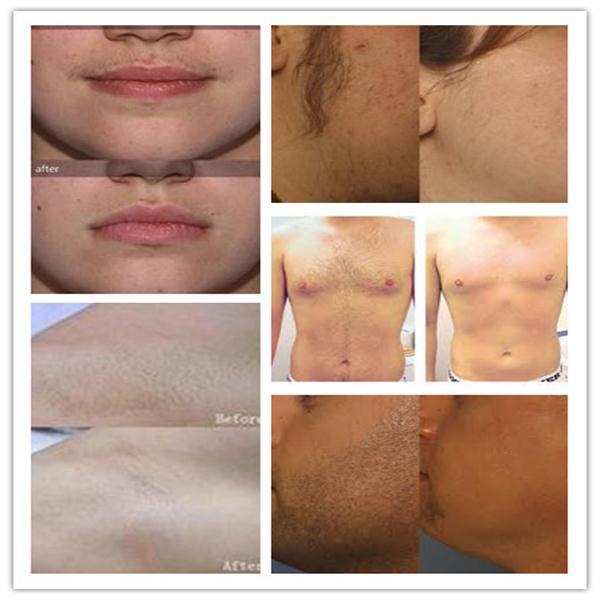 Permanent painless hair removal machine NUBWAY 808 diode laser hair removal