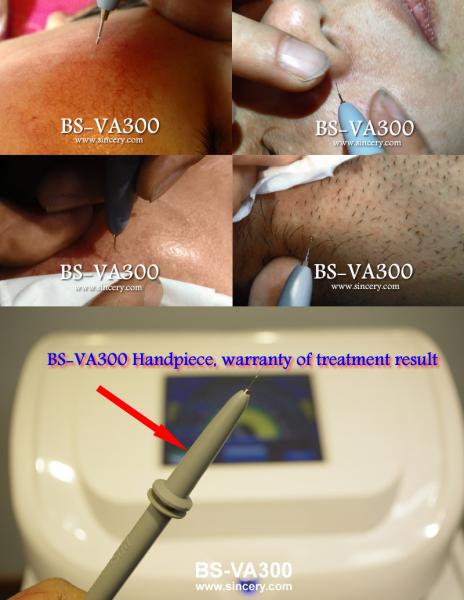 Vein Vascular removal High frequency vascular removal beauty machine coagulation vessels vein laser equipment for spider