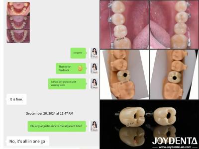 Long Lasting Full Arch Dental Implants Endosseous Implant Length 10mm-16mm