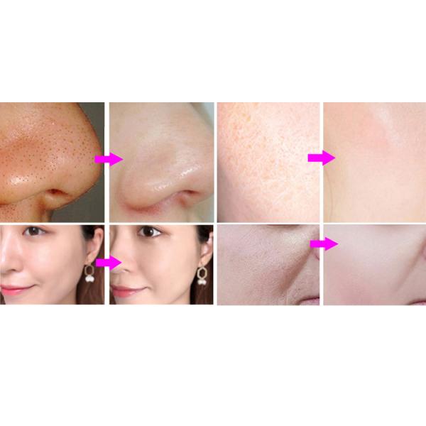 Smart Ice Blue Hydra Microdermabrasion Facial Skin Care Machine Hydra Dermabrasion Beauty Machine with Skin Analysis