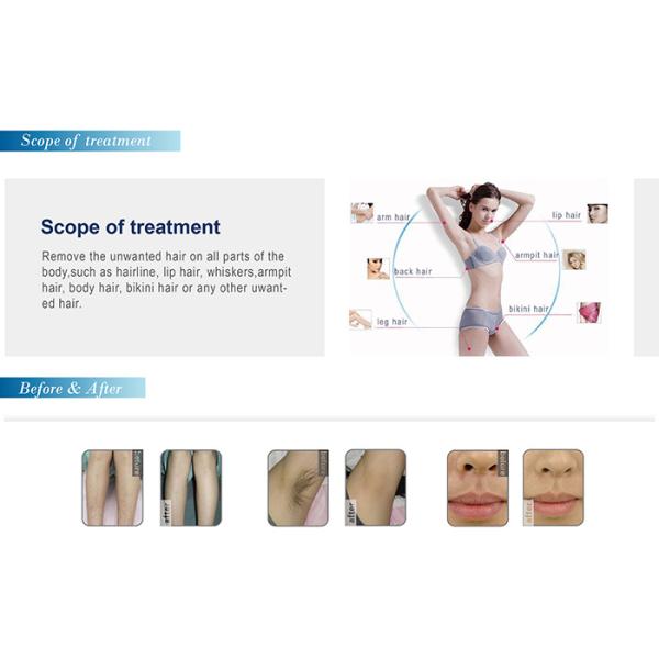 Alma hair removal epilator machine 808 depilation diode laser 810 nm hair removal