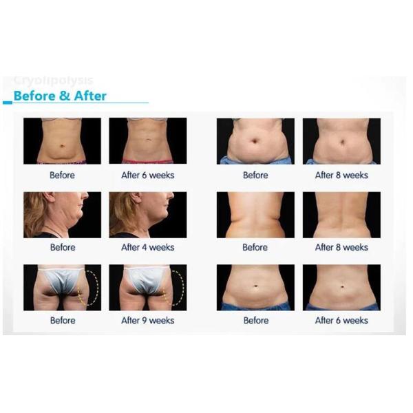 Salon / Clinic / Home Use Body Fat Freezing Machine Portable With Two Cryo Handles