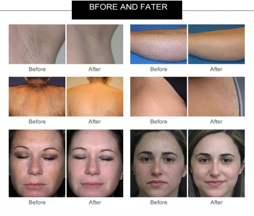 New Technolog 2021 IPL facial rejuvenation/ IPL device/beauty machine OPT