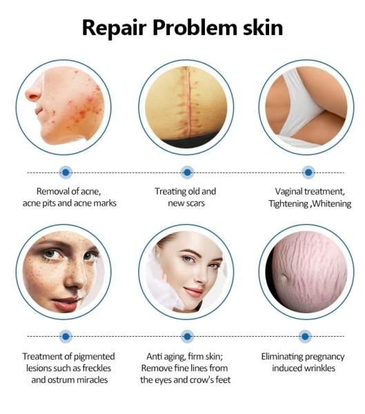 Fractional Co2 Laser Skin Resurfacing Carbon Dioxide Laser Tube Machine Pigmentation Remover For Face