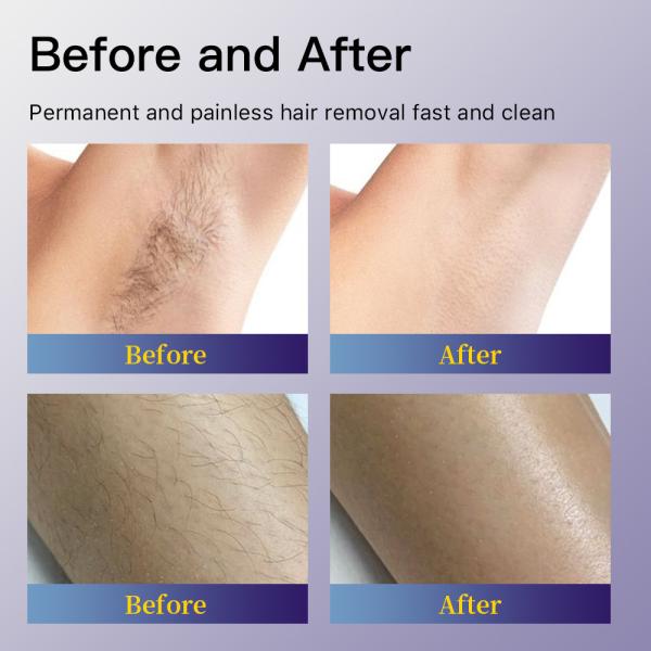 Q-Switch NO 755nm and 1064nm Alexandrite Laser Hair Removal Machine with Full Effect